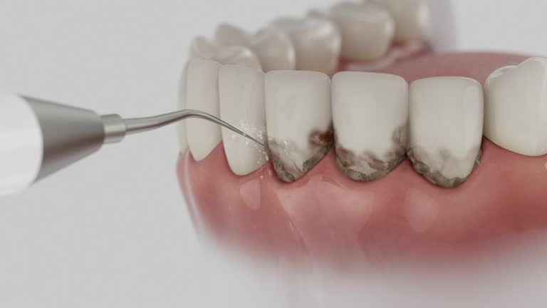Trusted Dental Crowns And Bridges service in Brandenburg, KY - Dentist Open Now
